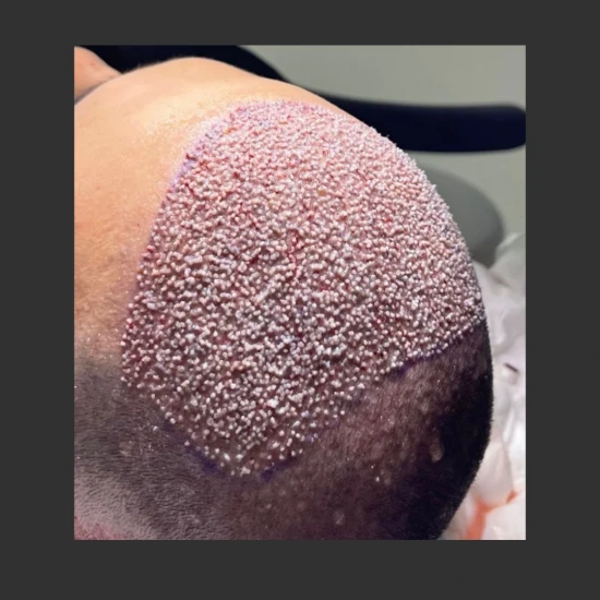 New Life Hair Transplant
