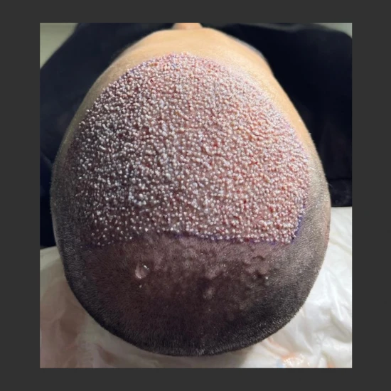 New Life Hair Transplant