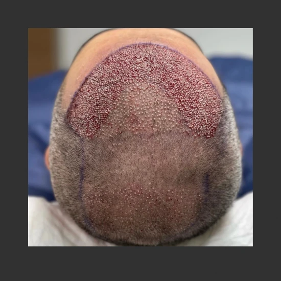New Life Hair Transplant