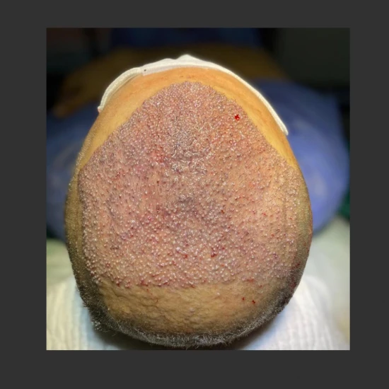 New Life Hair Transplant