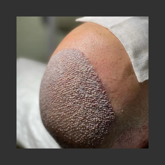 New Life Hair Transplant