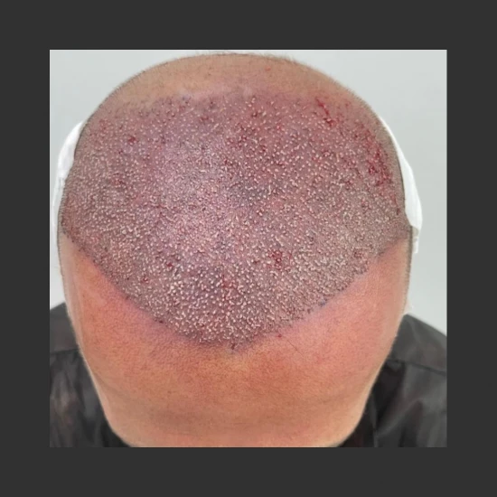 New Hair Life Transplant