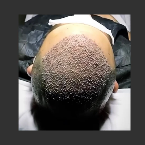 New Life Hair Transplant