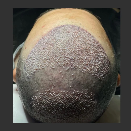 New Life Hair Transplant